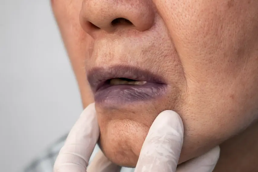 Cyanosis